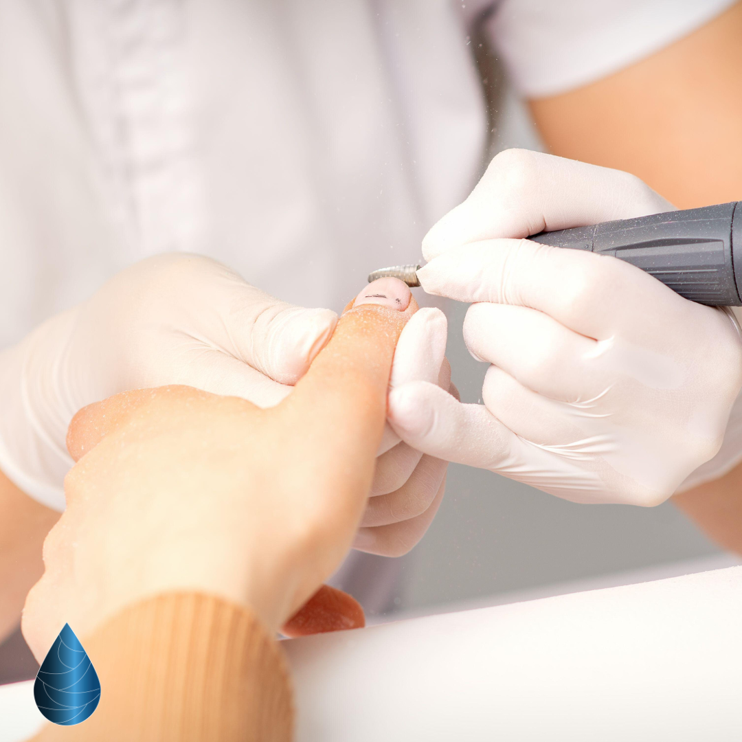 Dépose des ongles Le Cannet